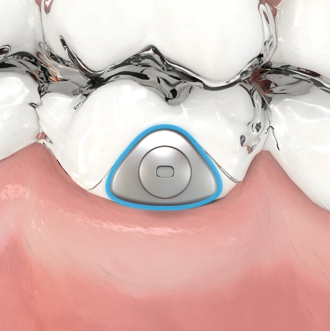 Aligner Buttons, Metall
